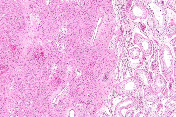 Tumore a cellule di Leydig al microscopio cane